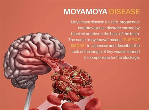 miu miu syndrome|Moyamoya disease .